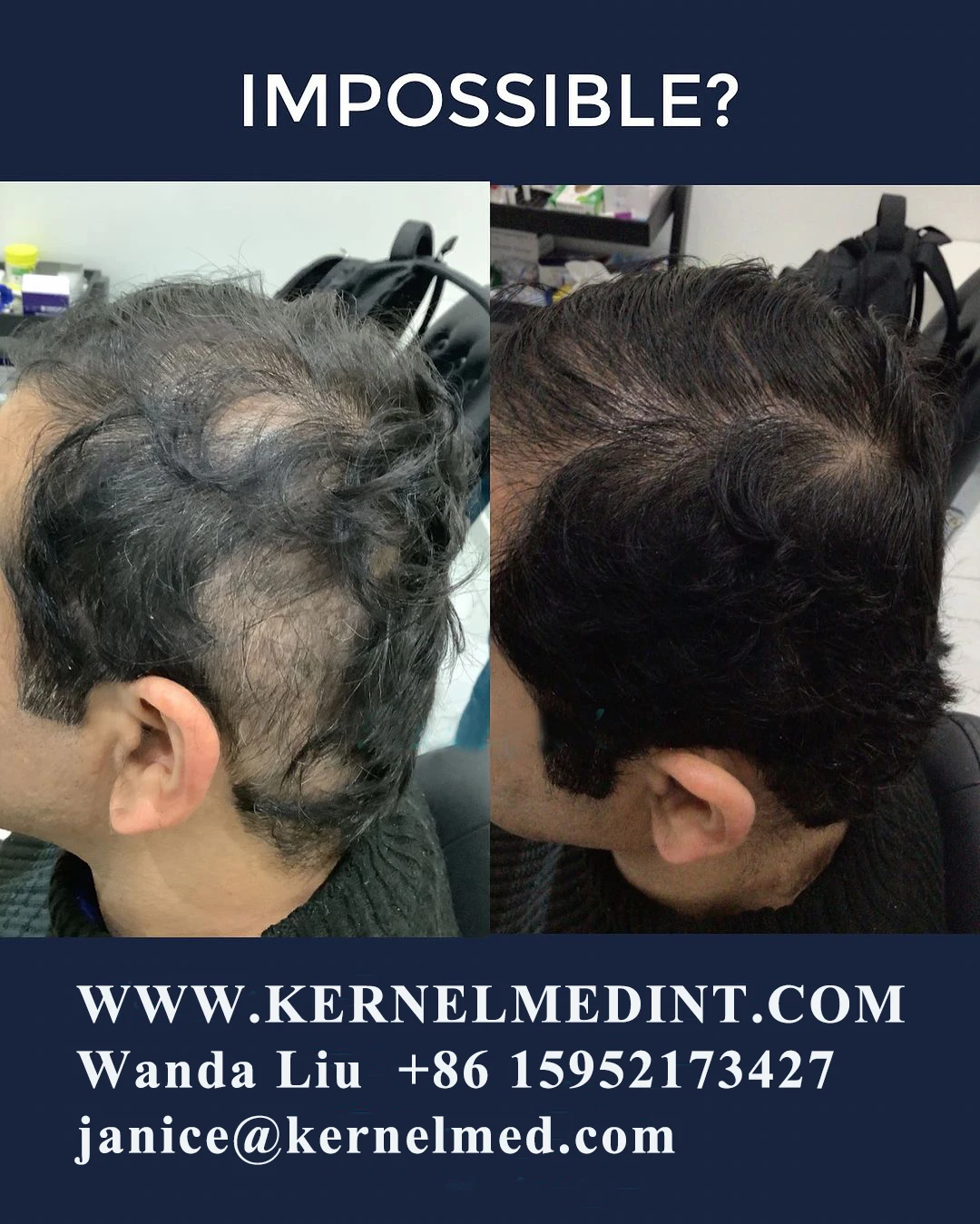 2024 Most Powerful with 424 pcs Medical Laser Diodes Low Level Light Therapy Hair Loss Treatment Machine KN-8000A