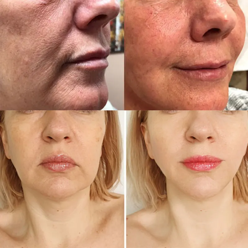 
hot selling top quality low price treatment twist pdo thread twin needles lifting korea 