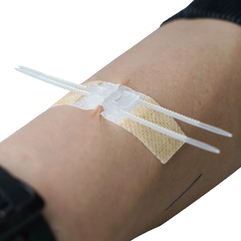 Medical Non-Woven Article Wound Closure Steri-Strip For Emergency Laceration Closures Topical Adhesive Zipper Wound Skin Closure