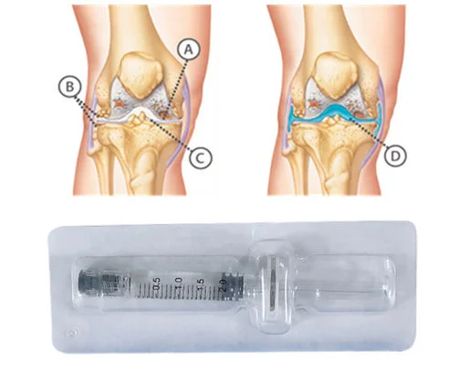 Knee joint injection knee hyaluronic acid hyaluronic acid injection knee cross link