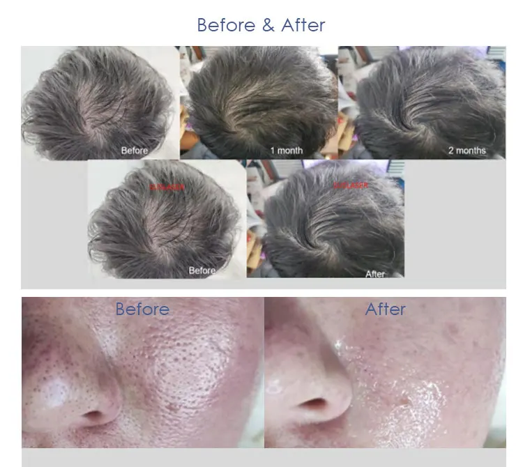 New arrival Derma Roller Skin Rejuvenation Facial Device Hair growth Machine