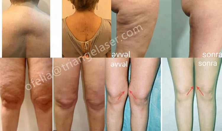 2020 Top sale 980nm Diode Laser for Liposuction