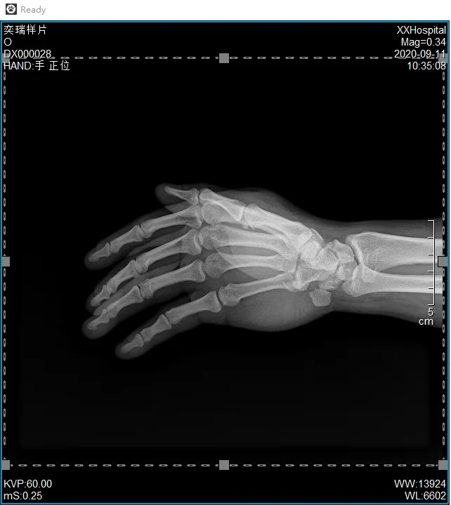 17*17 wireless High quality flat panel detector x ray detector digital xray CareView1800Cwe