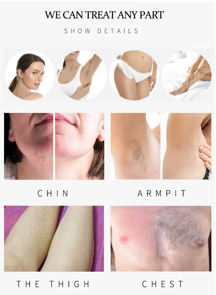 Diode Laser bar 755 808 1064nm Ice Titanium 3 Mini Wave Pulse Light SR Double Handpiece Hair Removal 2000W Permanent HR Machine