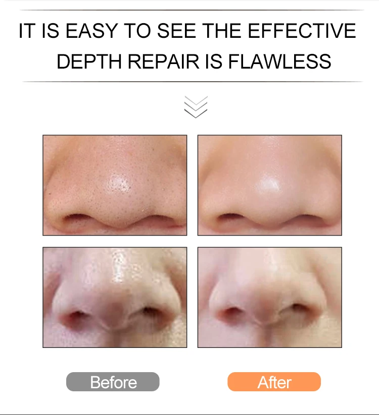 Send Inquiry to Get Free Samples pore vacuum blackhead remover Usb Rechargeable Acne Comedone Extractor Tool Machine