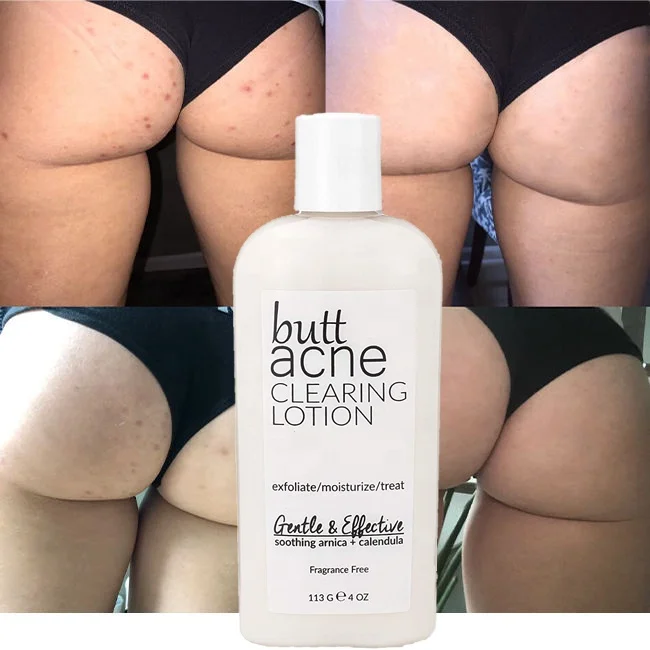 OEM Private Label Special Buttock Relieve Itching Acne Treatment Cream Butt Acne Clearing Lotion for Body, Back, Bum, & Thigh