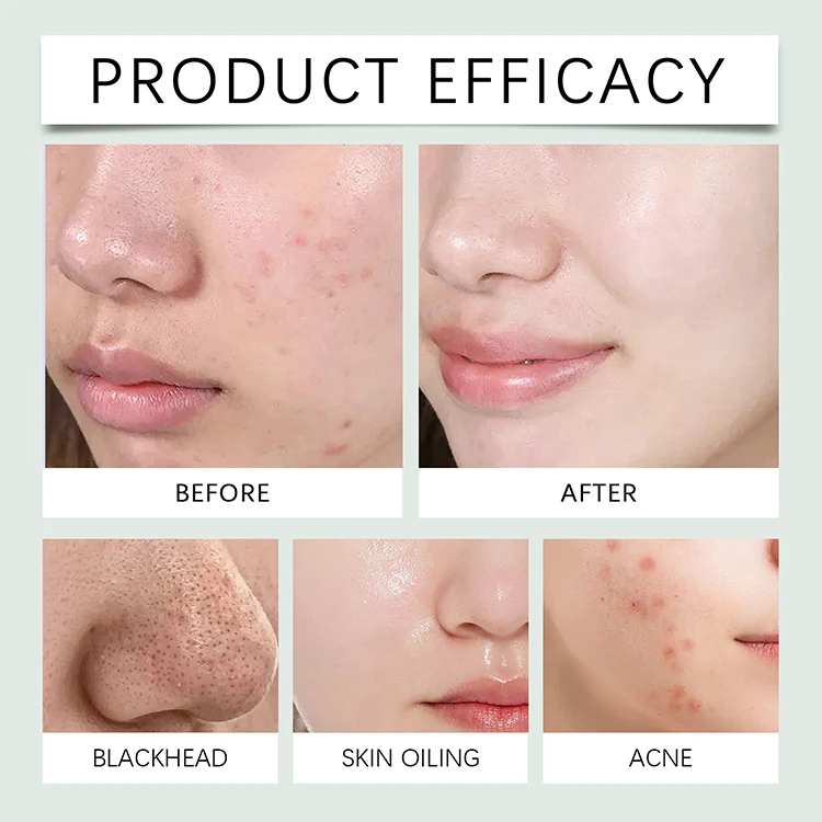 Private Label Natural Skin Care Deep Cleansing Treatment Acne Brightening Facial Mask Salicylic acid Anti Acne Clay Mud Mask
