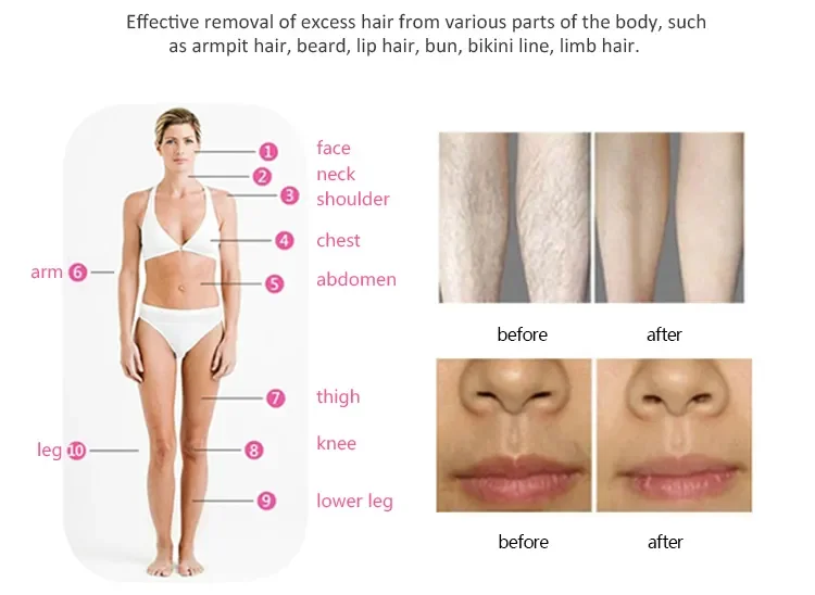 new ipl handpiece for ipl laser diode co2 fractional laser treatment ipl photofacial machine