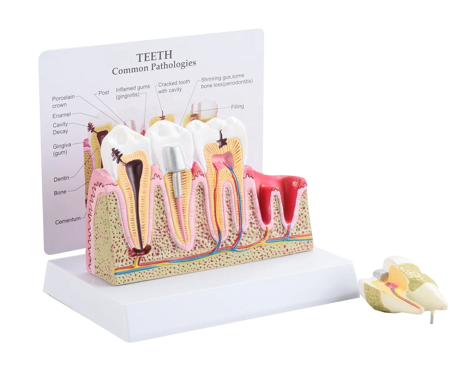 CBM-002E Education medical anatomical  model human teeth common pathologies model