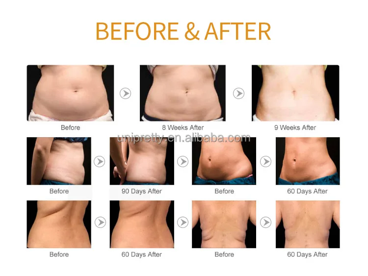 9 in 1/10 In 1 Multifunction Beauty Machine/ Lipolaser 40k/80k Vaccum Cavitation Vacuum Rf Slimming Beauty Cavitation Machine