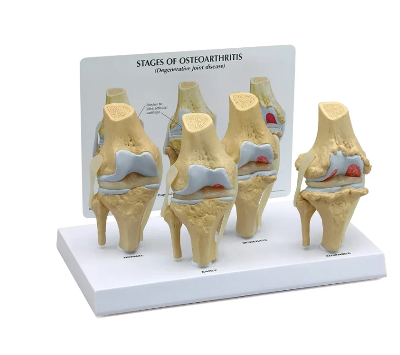 Медицинская наука коленного сустава модель Набор 4-х ступенчатый для больных остеоартритом докторов офисные образовательный