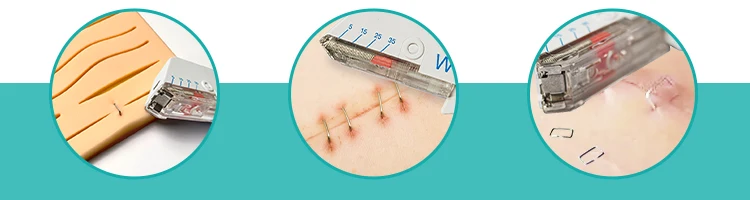 skin stapler and surgical staples