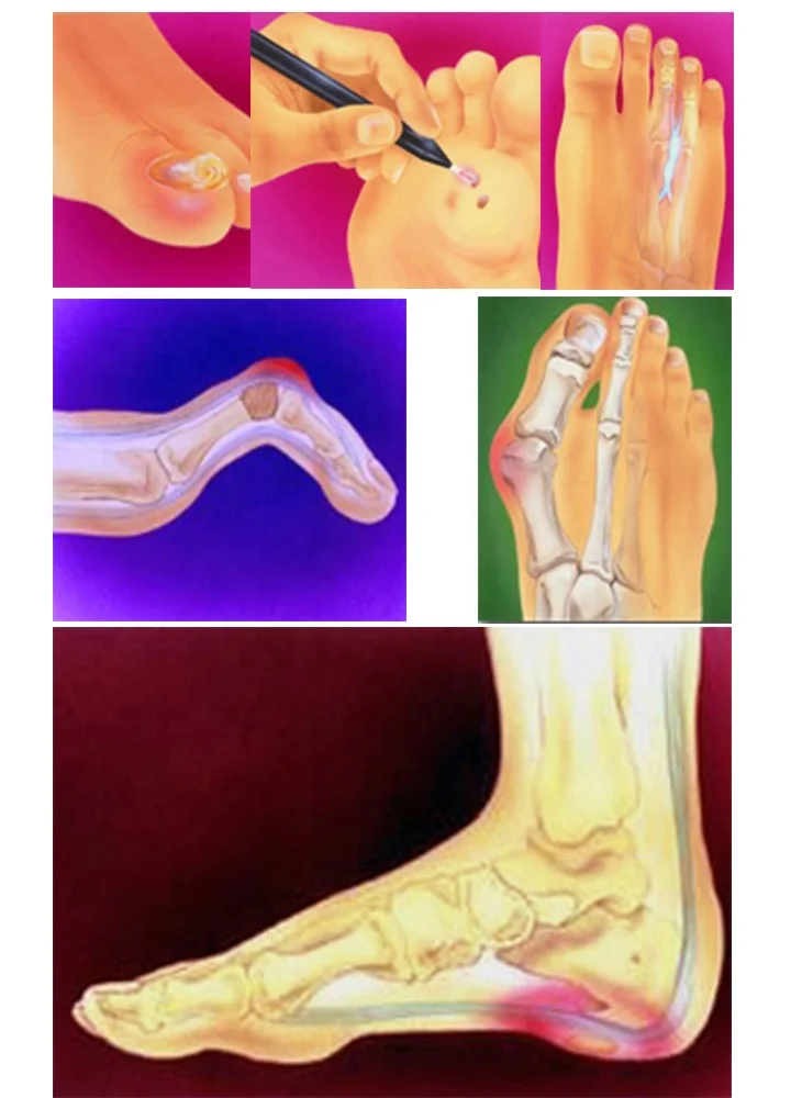 Новинка филас 980 нм лазерная терапия Podiatry грибок для ног на ногах 30 Вт глубокое удаление