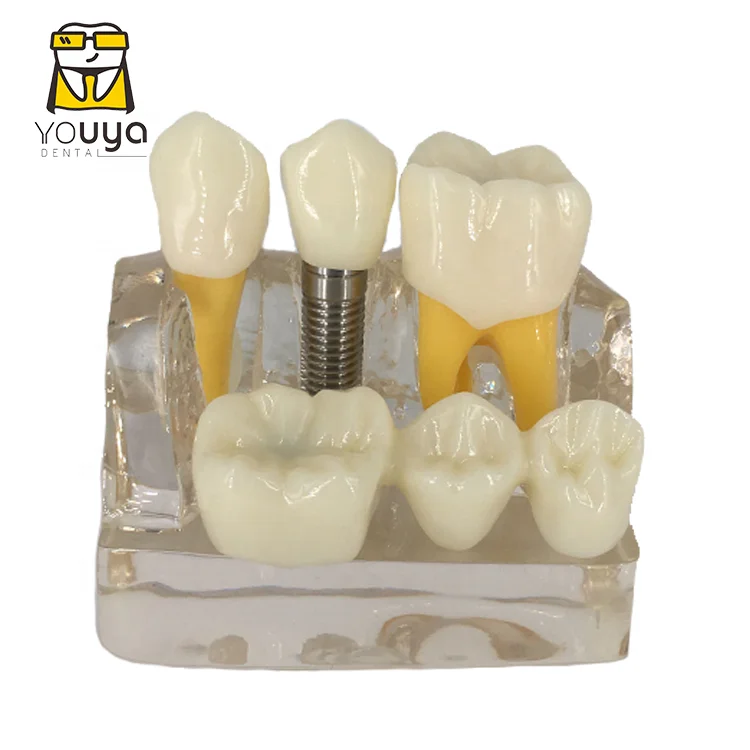 Dental Implant 4 Times Removable Teeth Model For Dental Clinic