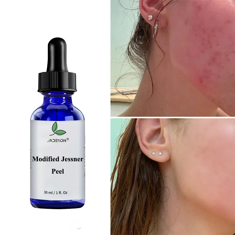 New Arrival Hot Selling  Modified Jessner Peel for Acne Hyperpigmentation Chemical Peel Solution for Skin Whitening