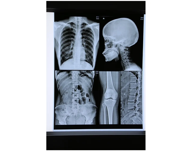 Medical X-Ray Thermal Film CT Scan 14x17inch x Ray Film Medical Film For Agfa Drystar 5302