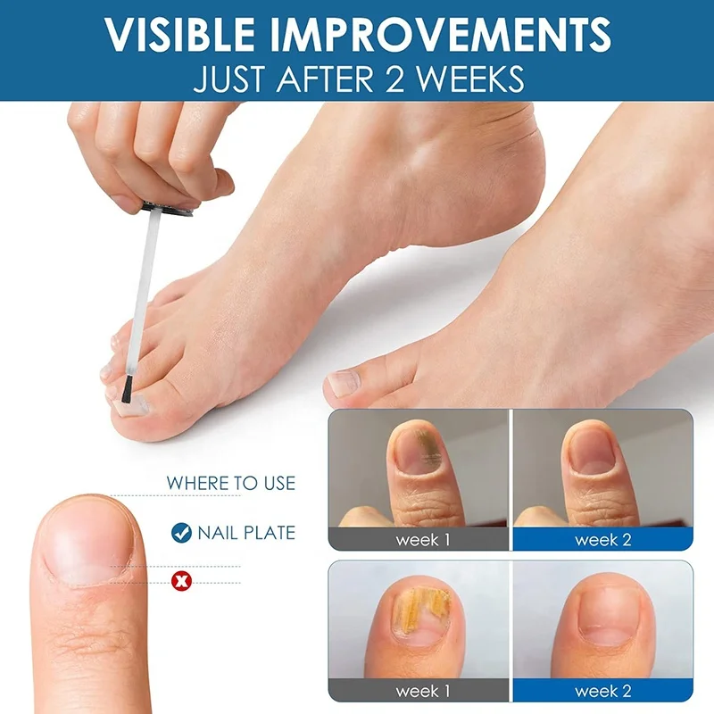 Toenail Fingernail Extra Strength Nail Repair Liquid Nail Repair Solution Thick Cracked Discolored Nail Toenail Fungus Treatment