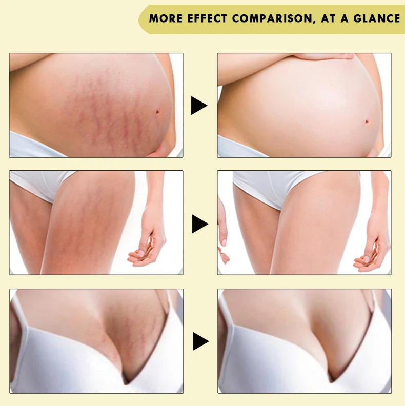 Pregnancy Stretch Mark Removal Cream Scar Stretch Marks Removal Gel