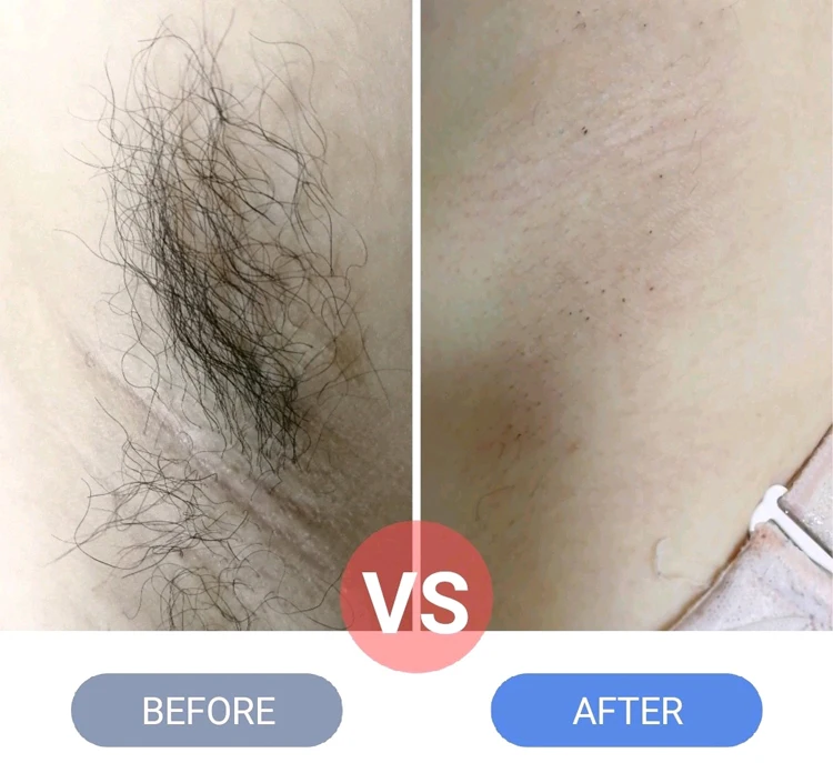 Latest Vacuum Laser 2400W  808Nm Diode Laser  31*23Nm  Large Spot Size Vacuum Suction Machine For Hair Removal