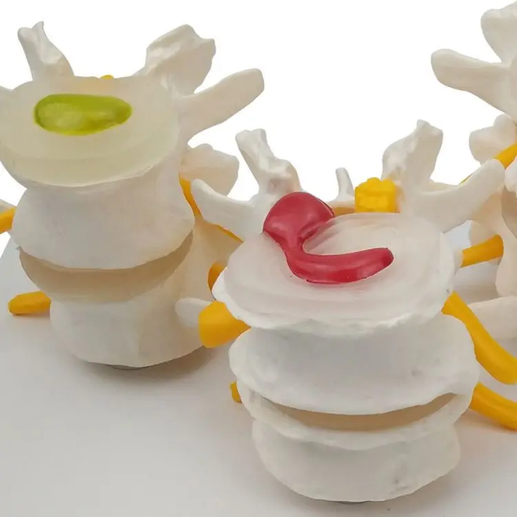 
The diseased model of vertebrae 