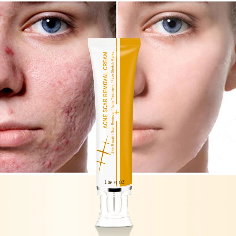Private Label Pimples Stretch Marks Remove Face Gel Tummy Tuck Tightening Stretch Mark Removal Cream Acne Scar Removal Cream