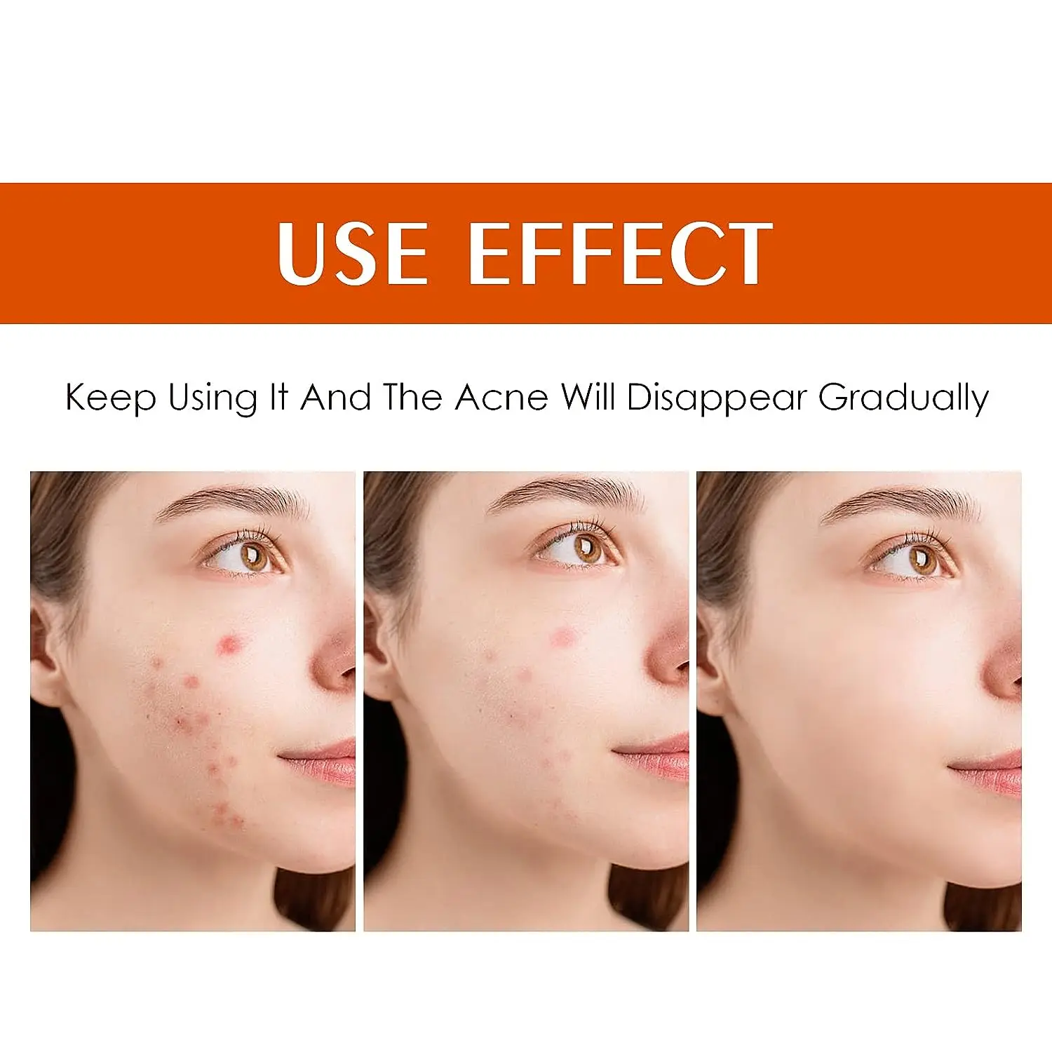 Натуральный веганский крем от акне с салициловой кислотой