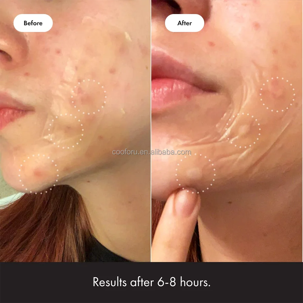 10 Patches Rectangular XL Hydrocolloid Large Cosmetics Surface Acne Pimple Patches for Body, Cheek, Forehead, and Chin With