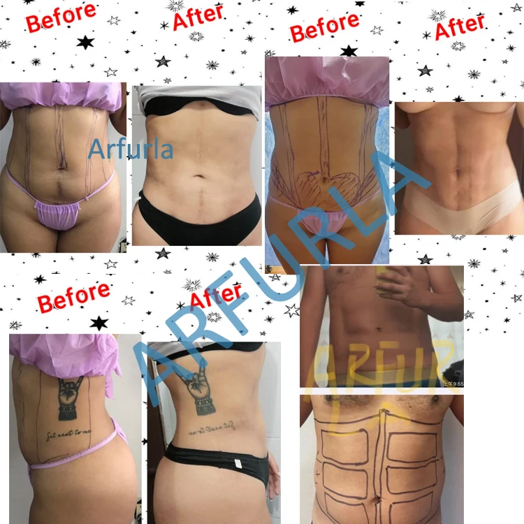endolift