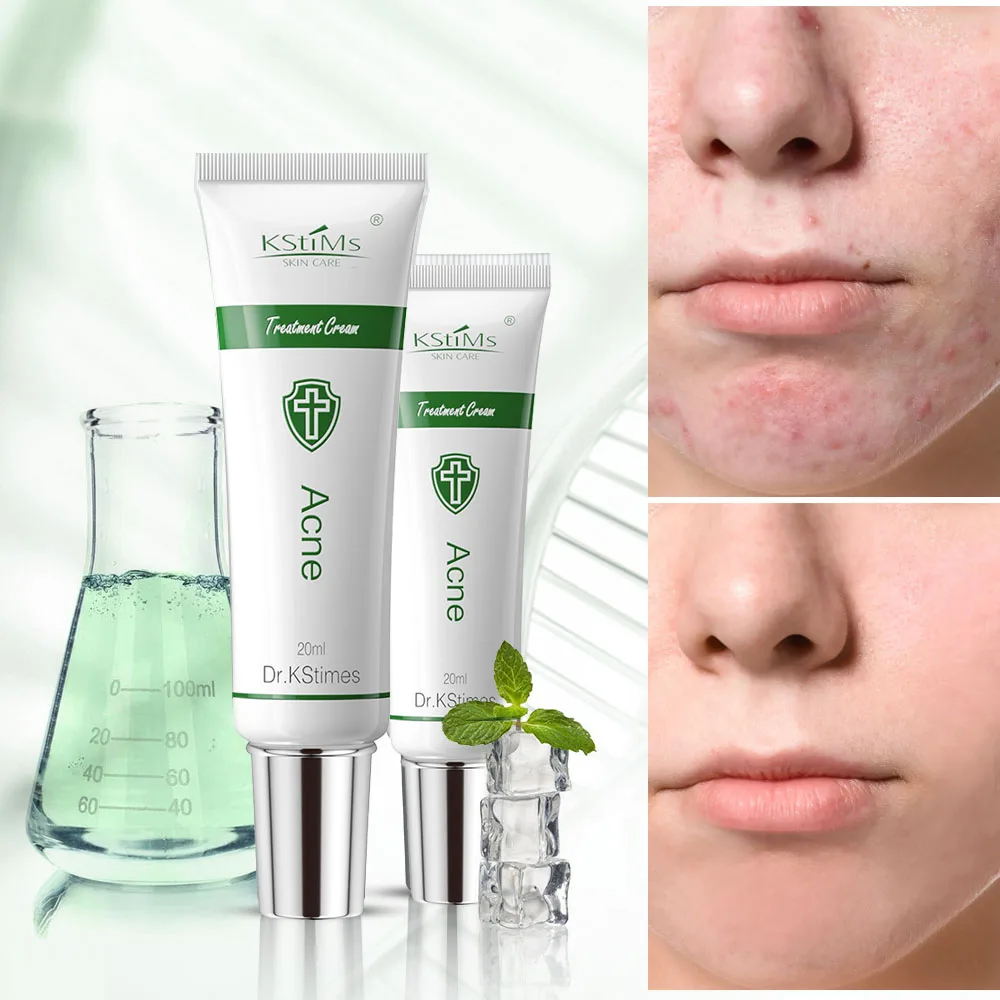 Best Herbal Acne Control Removing and Skin Lightening Face Cream For Acne with 20ml tube in Pakistan