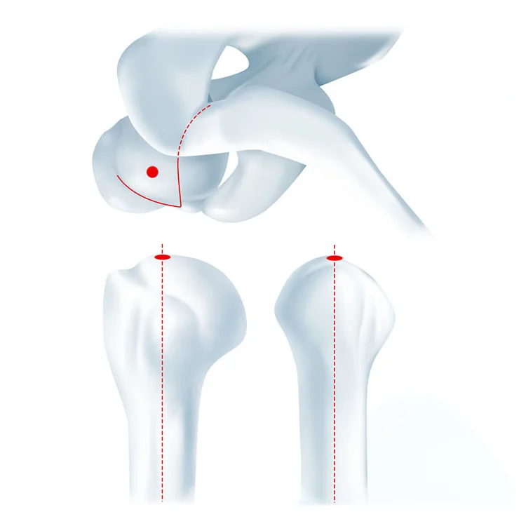 Trauma Orthopedic Implants Interlocking Titanium Nail Multi-Lock Humeral Intramedullary Nail