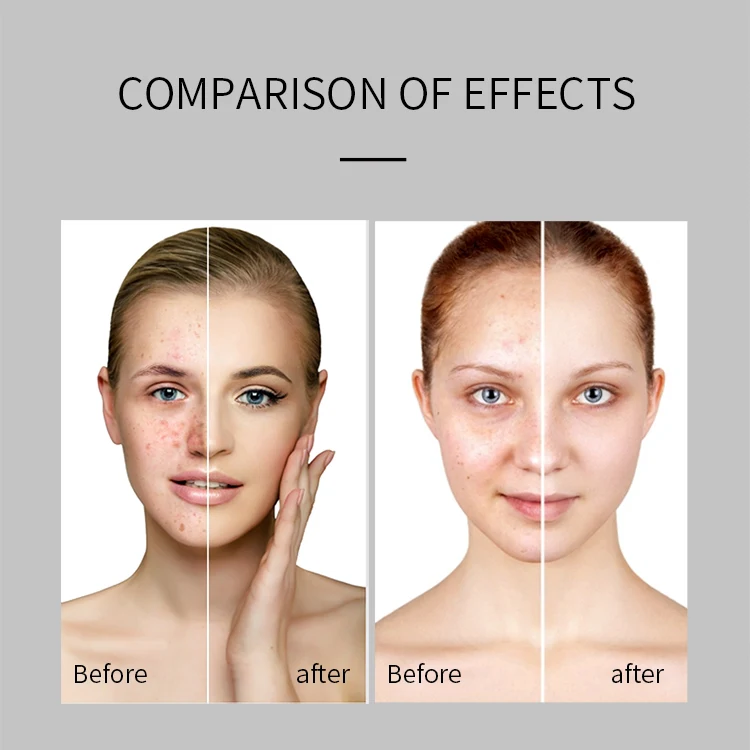 Private Label Againsts Acne And Oil Skin Serum Acne Repairing Essential