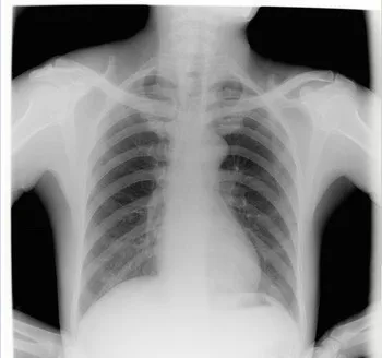 drystar agfa dt2b film hot sexy tube for x ray tube