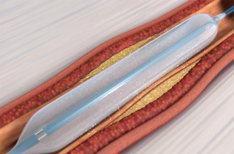 Balloon Dilatation Catheters Angioplasty Stent Balloon Inflator PTCA Semi-Compliant Ballon Cardiac Catheter Manufacturer