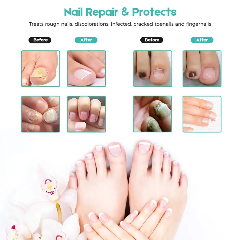 2PCS Nail Treatment From Fungus on Feet and Hand Disinfection Nail Fungal Treatment Oil Pen Manicure Treatment Tools