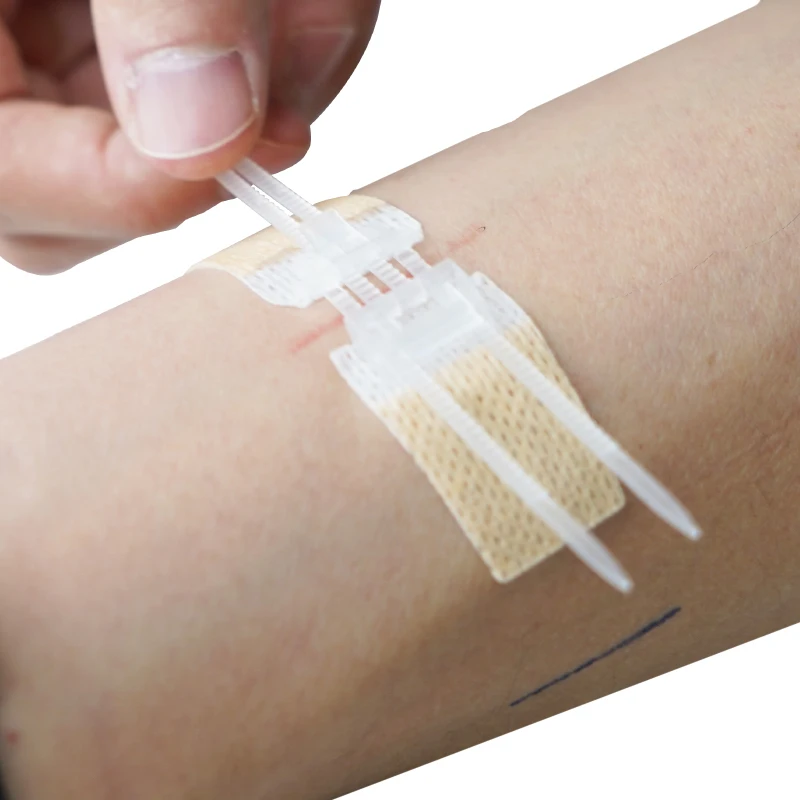 medical wound closure device non-invasive suture skin surface stapler zip stitch