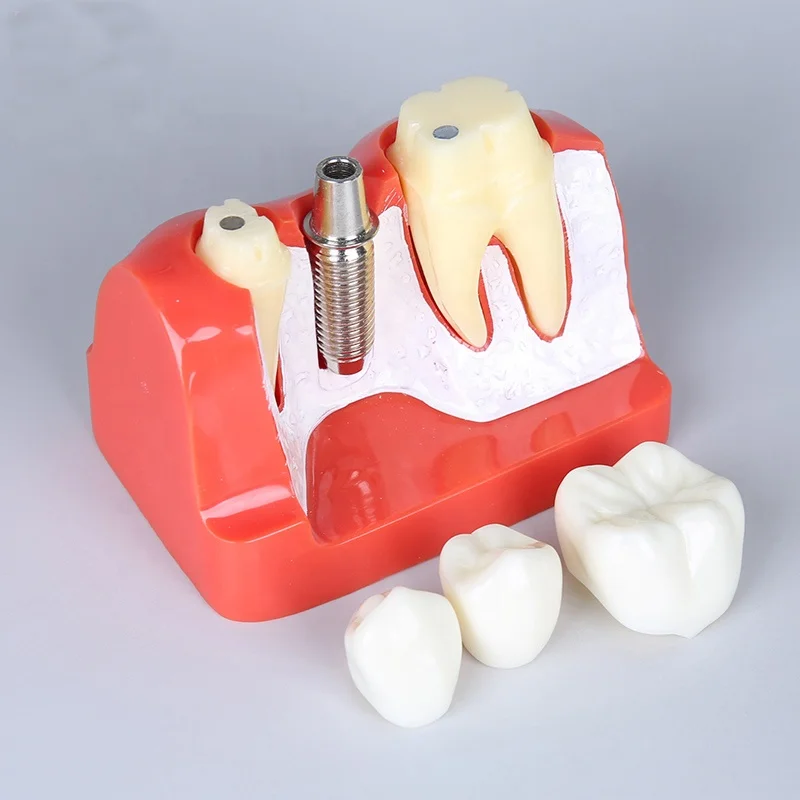 Съемная модель кариеса для зубов стоматологических принадлежностей демонстрация патологии