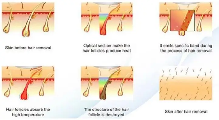Омоложение кожи лазерное удаление волос SH HR идеальный завод отличное послепродажное обслуживание качество гарантировано
