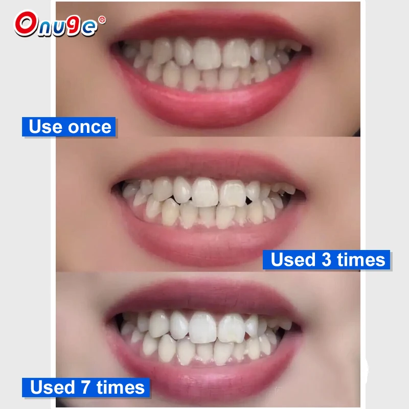 Onugesmile Manufactured Teeth Whitening Strips at Home Sensitive Office Non-alcoholic Tooth Whitening Strips