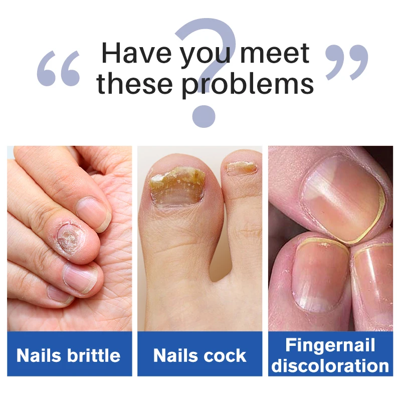 Private label natural nourishing hydrating smoothing foot care anti-fungus liquid toe nail fungus treatment