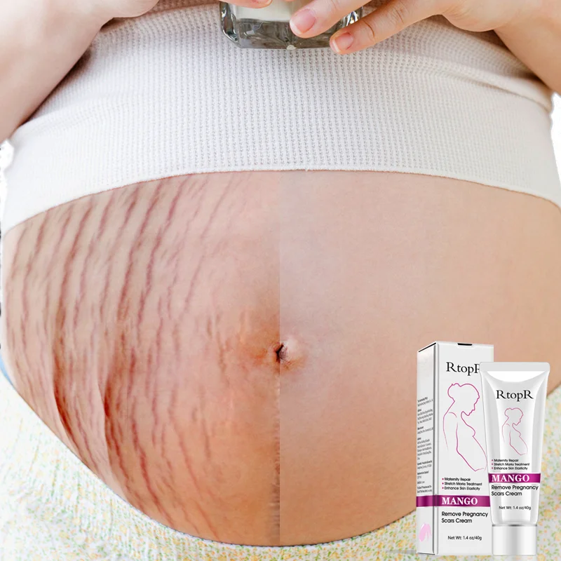 
Amazon Hot Private Logo Enhance Skin Elasticity Maternity Repair Stretch Marks Removal Cream  (1600200946531)