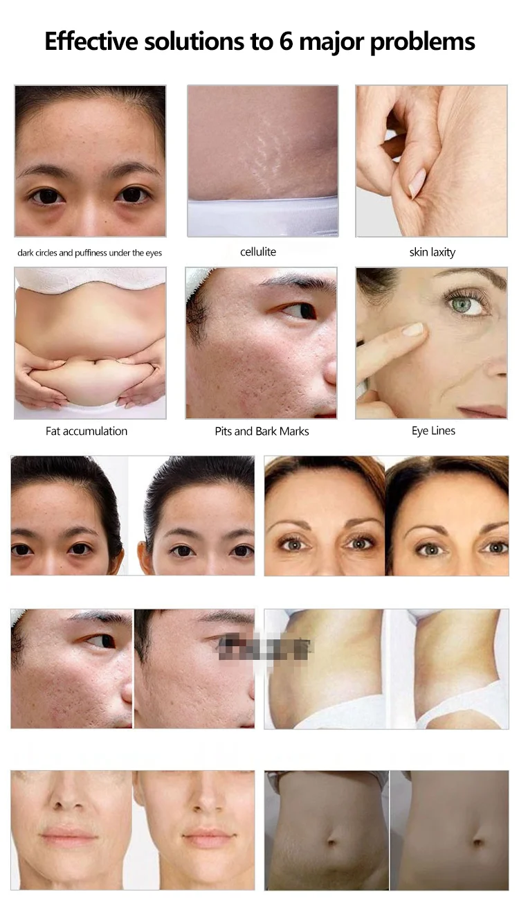 2024 Co2 Gas Cylinder Eye Dark Circle Removal Professional Carboxytherapy Mesotherapy Carboxy Therapy Machine Co2