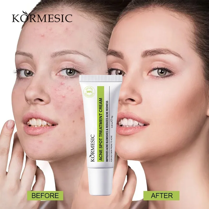 OEM HOT SALE KORMESIC ACNE SPOT Treatment Cream For oily Skin protect to Acne
