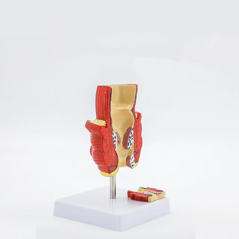 rectal hemorrhoids colorectal disease model Internal and external rectal hemorrhoids anorectal model