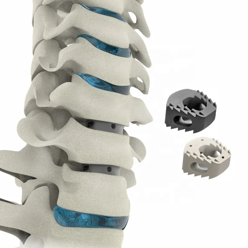 Implantable medical cervical peek implants