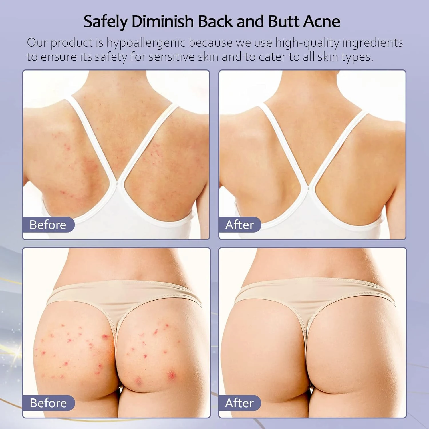 Private Label Acne Treatment Butt Acne Clearing Face Azelaic Acid Acne Cystic Scar Treatment Hormonal Cream