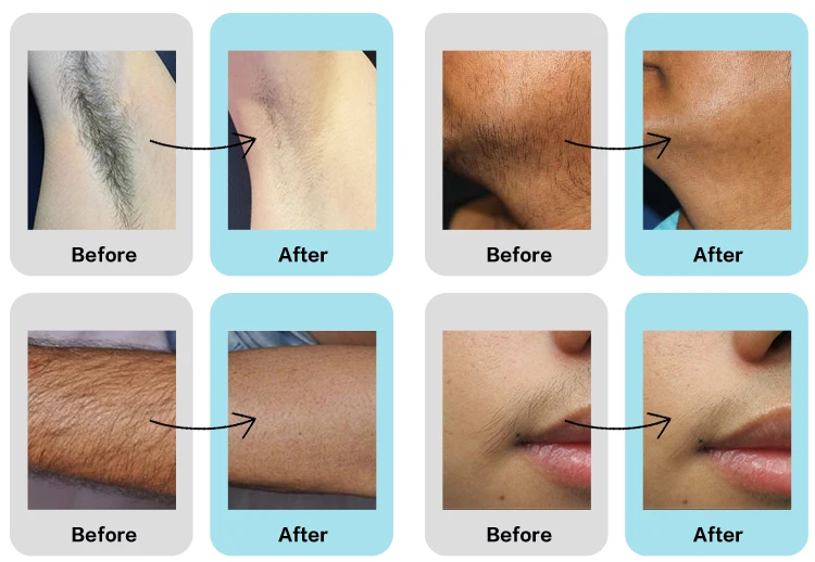 laser alexandrite (6)