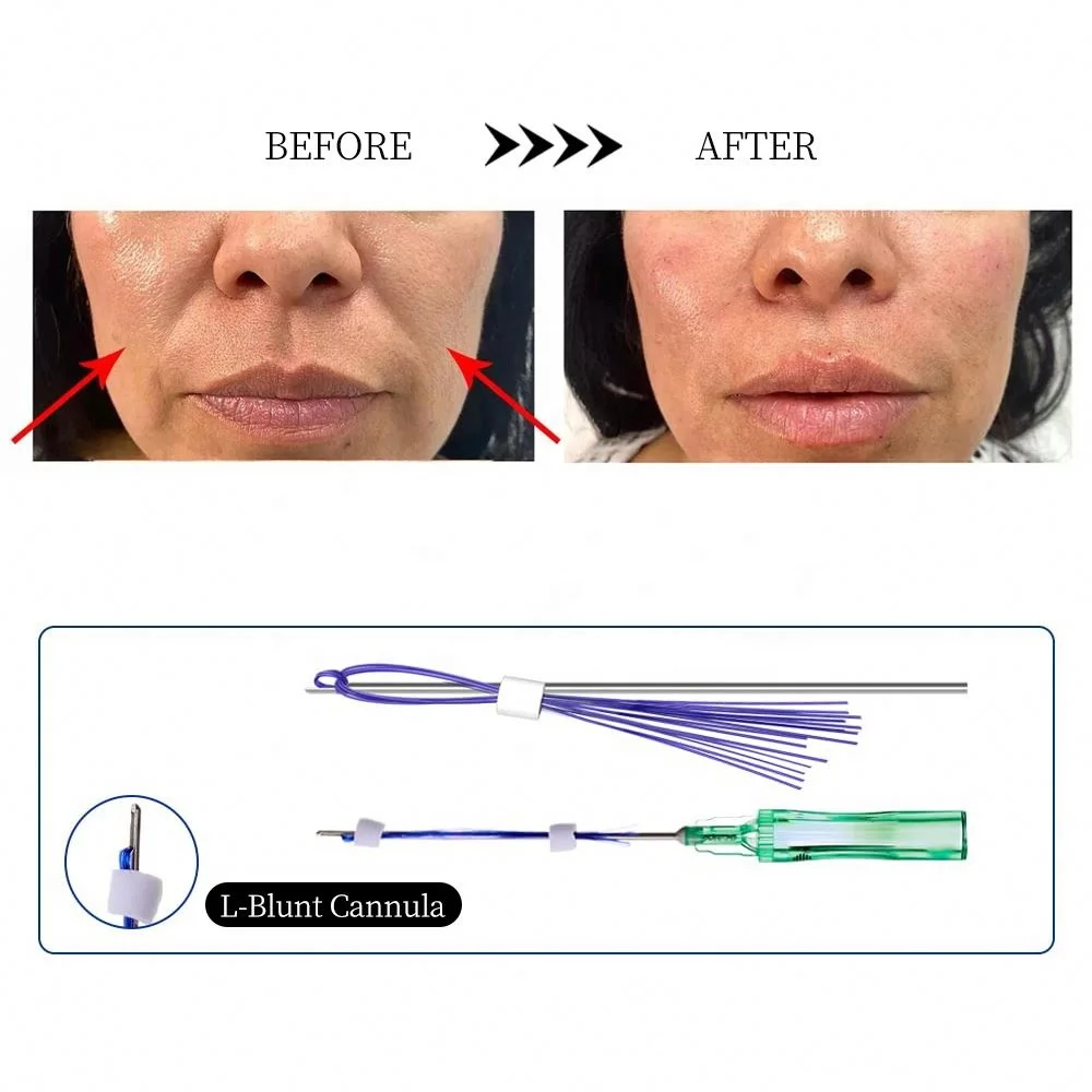 Pdo multi thread for face lift can be dispersed into several extremely thin PDO threads