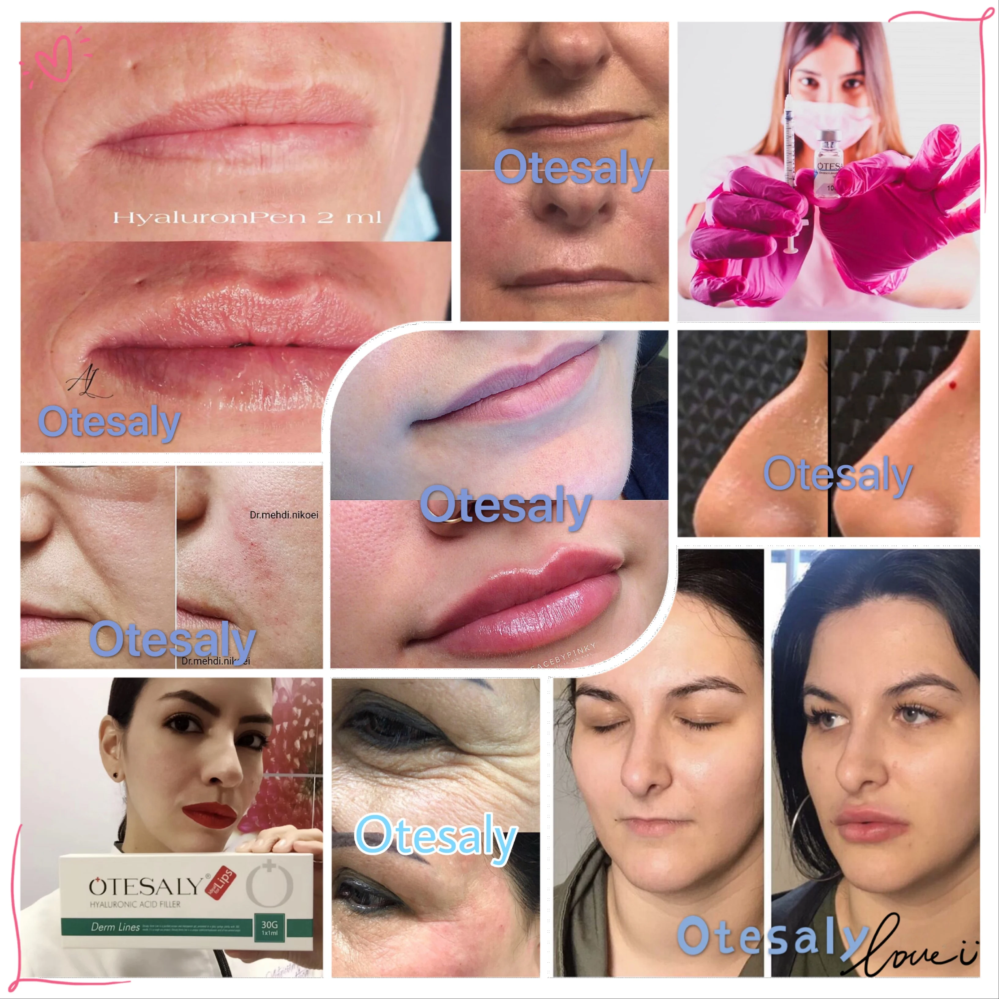 
CE ISO Approved 1ml Hyaluronic Acid Injectable Filler Women Men for Anti Wrinkle Nasolabial Folds with 0.3% Lido 