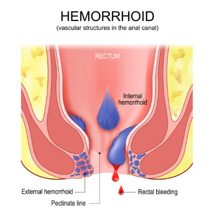 laser hemorrhoid 1470.png