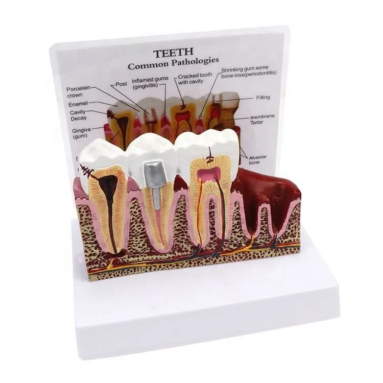 
Dental study model plastic periodontal teeth human medical decay teeth removable model 